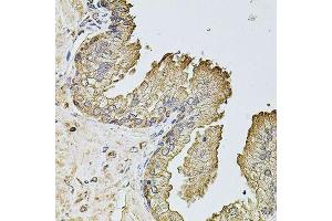 Immunohistochemistry of paraffin-embedded human prostate using PTCD3 antibody. (PTCD3 anticorps  (AA 450-689))