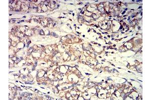 Immunohistochemical analysis of paraffin-embedded bladder cancer tissues using ACTR3 mouse mAb with DAB staining.