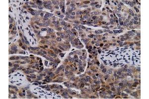 Immunohistochemical staining of paraffin-embedded Carcinoma of Human lung tissue using anti-NT5DC1 mouse monoclonal antibody. (NT5DC1 anticorps)