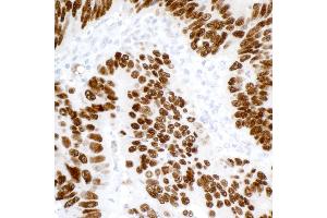 Immunohistochemistry (IHC) image for anti-Tumor Protein P53 (TP53) (AA 20-25) antibody (ABIN7455068) (p53 anticorps  (AA 20-25))