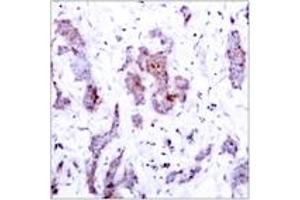 Immunohistochemistry analysis of paraffin-embedded human breast carcinoma tissue, using Rel (Ab-503) Antibody. (c-Rel anticorps  (AA 470-519))