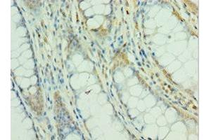 Immunohistochemistry of paraffin-embedded human colon cancer using ABIN7160504 at dilution of 1:100 (MEF2C anticorps  (AA 170-380))