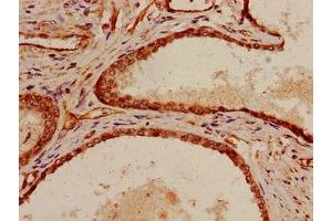 Immunohistochemistry of paraffin-embedded human prostate cancer using ABIN7169511 at dilution of 1:100 (SHC1 anticorps  (AA 207-370))