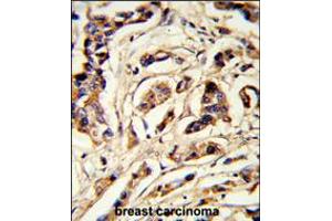 Formalin-fixed and paraffin-embedded human breast carcinoma reacted with TSHB Antibody , which was peroxidase-conjugated to the secondary antibody, followed by DAB staining. (TSHB anticorps  (AA 58-86))