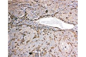 IHC-P: Gelsolin antibody testing of human lung cancer tissue.