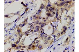 ABIN6267452 at 1/200 staining human lung cancer tissue sections by IHC-P.