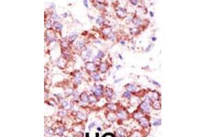 Formalin-fixed and paraffin-embedded human cancer tissue reacted with the primary antibody, which was peroxidase-conjugated to the secondary antibody, followed by AEC staining. (USP4 anticorps  (C-Term))