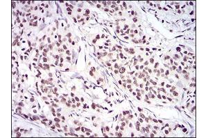 Immunohistochemical analysis of paraffin-embedded cervical cancer tissues using XRCC6 mouse mAb with DAB staining. (XRCC6 anticorps  (AA 6-214))