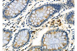 ABIN6261833 and ABIN6273246 at 1/100 staining Human colorectal cancer by IHC-P. (FXR1 anticorps  (Internal Region))