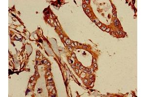 Immunohistochemistry of paraffin-embedded human pancreatic cancer using ABIN7145576 at dilution of 1:100 (ATIC anticorps  (AA 301-592))