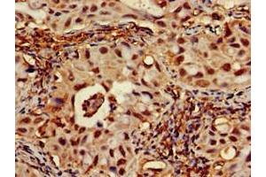 Immunohistochemistry of paraffin-embedded human lung cancer using ABIN7167701 at dilution of 1:100