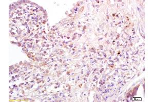 Formalin-fixed and paraffin embedded human lung carcinoma labeled with Anti-B7-1/CD80 Polyclonal Antibody, Unconjugated at 1:200 followed by conjugation to the secondary antibody and DAB staining (CD80 anticorps  (AA 251-321))