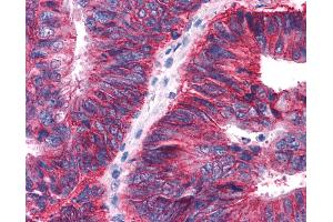 Anti-APLNR/ Apelin Receptor / APJ antibody IHC of human Colon, Carcinoma.