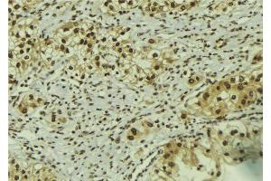 ABIN6267182 at 1/100 staining Human breast cancer tissue by IHC-P. (SMAD1 anticorps  (pSer206))