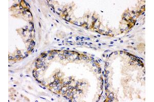 Anti- SAP97 Picoband antibody, IHC(P) IHC(P): Human Prostatic Cancer Tissue (DLG1 anticorps  (AA 1-165))