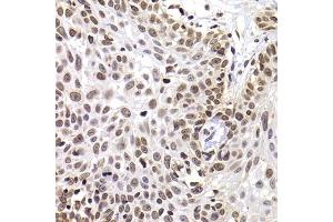 Immunohistochemistry of paraffin-embedded human well-differentiated squamous skin carcinoma using PHIP antibody (ABIN6129078, ABIN6145556, ABIN6145557 and ABIN6223036) at dilution of 1:100 (40x lens). (PHIP anticorps  (AA 1542-1821))