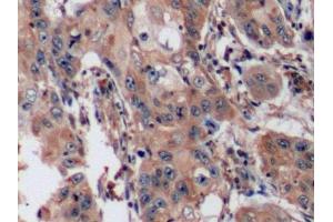 Detection of CD15 in Human Lymphoma Tissue using Polyclonal Antibody to Cluster Of Differentiation 15 (CD15)