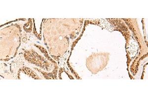 Immunohistochemistry of paraffin-embedded Human thyroid cancer tissue using FUNDC2 Polyclonal Antibody at dilution of 1:50(x200) (FUNDC2 anticorps)