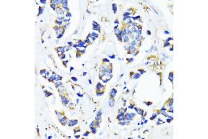 Immunohistochemistry of paraffin-embedded human breast cancer using MRPL45 antibody (ABIN6133218, ABIN6144020, ABIN6144021 and ABIN6217105) at dilution of 1:100 (40x lens). (MRPL45 anticorps  (AA 57-306))