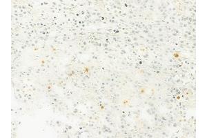 ABIN6263779 and ABIN6279623 at 1/100 staining human non-Hodgkin lymphoma by IHC-P.