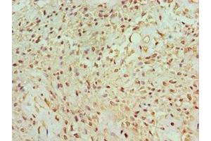 Immunohistochemistry of paraffin-embedded human breast cancer using ABIN7165122 at dilution of 1:100