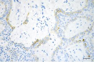Immunohistochemistry was performed on paraffin-embedded human hemangioma using RAS p21 protein activator 1 antibody (ABIN7800111), 1:200). (Recombinant RACGAP1 anticorps)