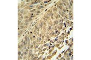 Immunohistochemistry analysis in formalin fixed and paraffin embedded human bladder carcinoma reacted with HNRNPC Antibody (C-term) followed by peroxidase conjugation of the secondary antibody and DAB staining. (HNRNPC anticorps  (C-Term))