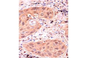 Immunohistochemistry of paraffin-embedded Human lung cancer using RPP38 Rabbit pAb (ABIN7269983) at dilution of 1:100 (40x lens). (RPP38 anticorps  (AA 20-110))