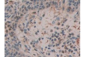 Detection of QSOX1 in Human Skin cancer Tissue using Polyclonal Antibody to Quiescin Q6 Sulfhydryl Oxidase 1 (QSOX1)