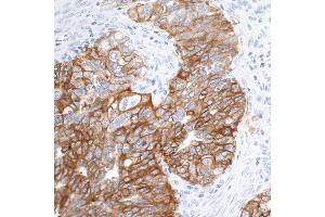Immunohistochemistry (IHC) image for anti-Epithelial Cell Adhesion Molecule (EPCAM) (AA 264-314) antibody (ABIN7454025) (Recombinant EpCAM anticorps  (AA 264-314))