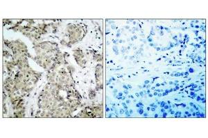 Immunohistochemical analysis of paraffin- embedded human breast carcinoma tissue, using MKK6 (phospho-Ser207) antibody (E011146). (MAP2K6 anticorps  (pSer207))