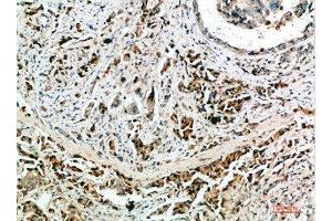 Immunohistochemical analysis of paraffin-embedded human-breast-cancer, antibody was diluted at 1:200 (Nanos Homolog 1 anticorps  (AA 151-200))