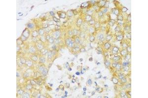 Immunohistochemistry of paraffin-embedded Human liver cancer using ERLIN1 Polyclonal Antibody at dilution of 1:100 (40x lens). (ERLIN1 anticorps)