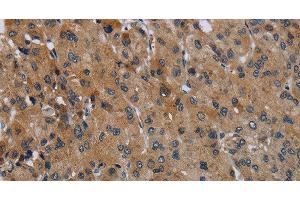 Immunohistochemistry of paraffin-embedded Human liver cancer using FAAH Polyclonal Antibody at dilution of 1:50 (FAAH anticorps)