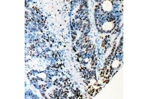 Immunohistochemical analysis of RB1 staining in human colon cancer formalin fixed paraffin embedded tissue section. (Retinoblastoma 1 anticorps)