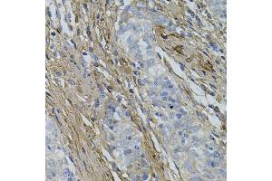 Immunohistochemistry of paraffin-embedded human esophageal cancer using COL1A1 antibody (ABIN5997480) at dilution of 1/100 (40x lens). (COL1A1 anticorps)