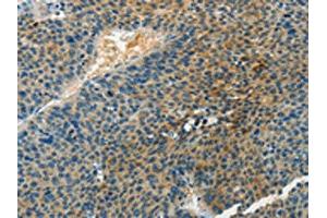 The image on the left is immunohistochemistry of paraffin-embedded Human liver cancer tissue using ABIN7190467(DGKB Antibody) at dilution 1/60, on the right is treated with synthetic peptide. (DGKB anticorps)