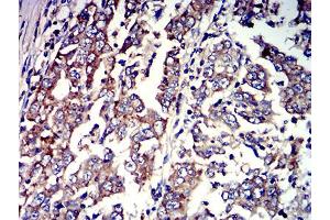 Immunohistochemical analysis of paraffin-embedded stomach cancer tissues using P2RY4 mouse mAb with DAB staining.