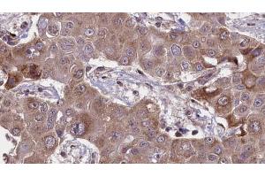ABIN6269031 at 1/100 staining Human liver cancer tissue by IHC-P. (PDGFRA anticorps  (C-Term))