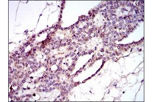 Immunohistochemical analysis of paraffin-embedded ovarian cancer tissues using PIWIL4 mouse mAb with DAB staining.
