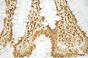 Immunohistochemistry was performed on paraffin-embedded human sigmoid colon carcinoma using histone H3 (mono methyl K9) antibody (ABIN7798962), 1:200). (Recombinant Histone 3 anticorps  (H3K9me1))