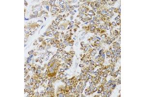 Immunohistochemistry of paraffin-embedded human liver cancer using  antibody (ABIN6129960, ABIN6136680, ABIN6136681 and ABIN6224707) at dilution of 1:100 (40x lens).