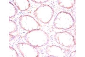 Immunohistochemistry of paraffin-embedded human colon cancer using ABIN7165284 at dilution of 1:50