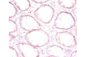 Immunohistochemistry of paraffin-embedded human colon cancer using ABIN7165284 at dilution of 1:50 (P4HB anticorps  (AA 29-508))