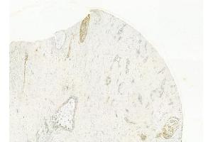 ABIN6262096 and ABIN6278471 at 1/100 staining human hepatocellular carcinoma by IHC-P. (GRO gamma anticorps  (C-Term))