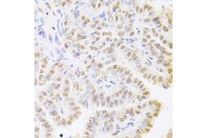 Immunohistochemistry of paraffin-embedded human thyroid cancer using HDGF Antibody. (HDGF anticorps  (AA 1-240))