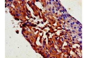 Immunohistochemistry of paraffin-embedded human breast cancer using ABIN7169527 at dilution of 1:100 (TRPC1 anticorps  (AA 39-207))