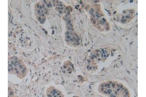 Detection of GAD2 in Human Breast cancer Tissue using Polyclonal Antibody to Glutamate Decarboxylase 2 (GAD2)