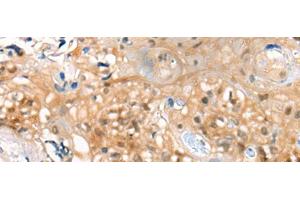 Immunohistochemistry of paraffin-embedded Human esophagus cancer tissue using CBR3 Polyclonal Antibody at dilution of 1:35(x200) (CBR3 anticorps)