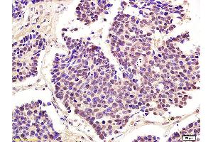 Formalin-fixed and paraffin embedded human lung carcinoma labeled with Anti-Phospho-cdc2 (Thr161) Polyclonal Antibody, Unconjugated (ABIN746978) at 1:200 followed by conjugation to the secondary antibody and DAB staining (CDK1 anticorps  (pThr161))